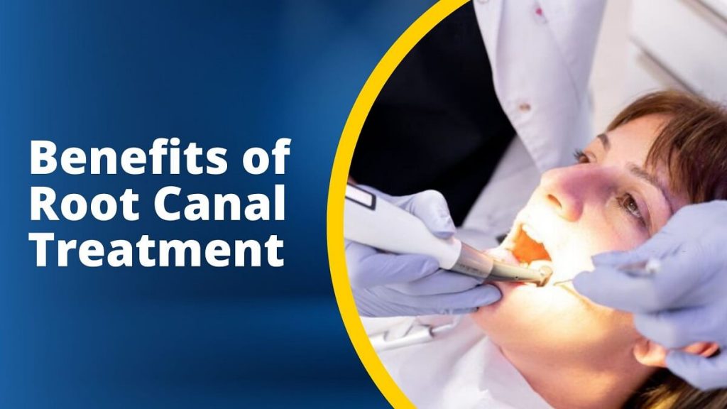 Benefits of Root Canal Treatment